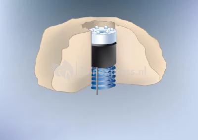 1 LED-LIGHT Met Vervangbare LED Krans - Afbeelding 3